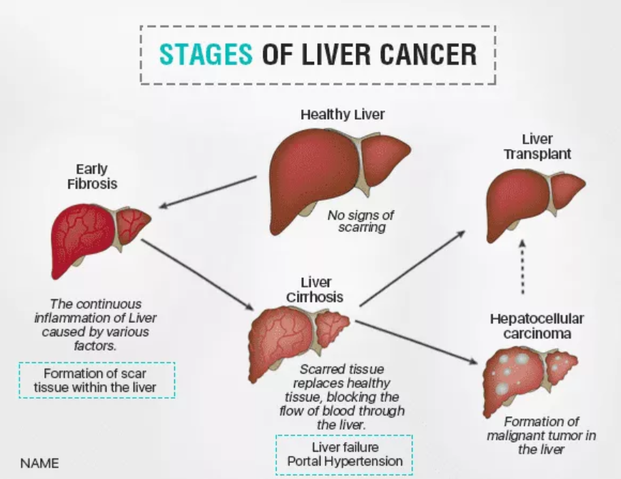 liver cancer symptoms