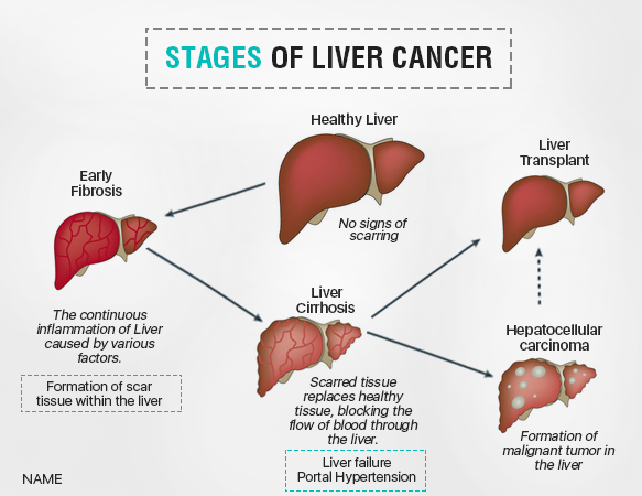 Liver Cancer Types And Stages