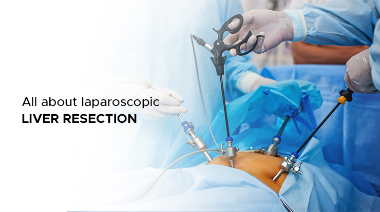 Everything you Need to Know About Laparoscopic Liver Resection
