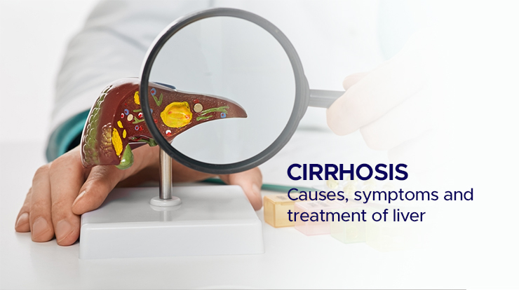 cirrhosis causes, symptoms and treatment of liver