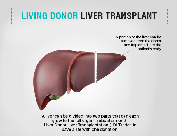 Living Donor Liver Transplant