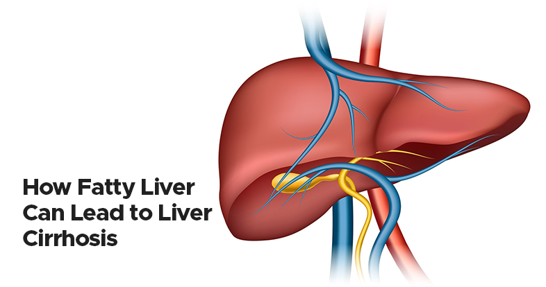 how fatty liver can lead to liver cirrhosis