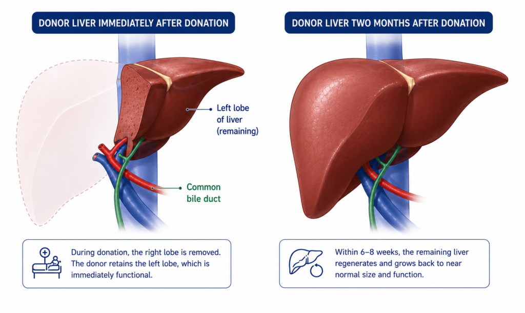Liver regeneration after living donor liver donation showing the donor liver immediately after surgery and two months later